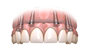 Full Mouth Hybridge Teeth Solutions
