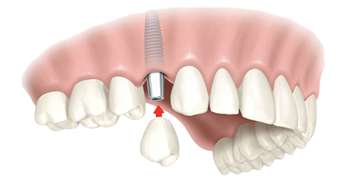 Single Dental Implants Aurora