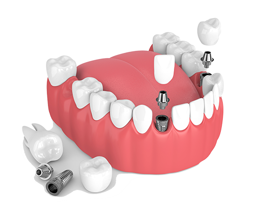 Multiple Teeth Dental Implants in Aurora